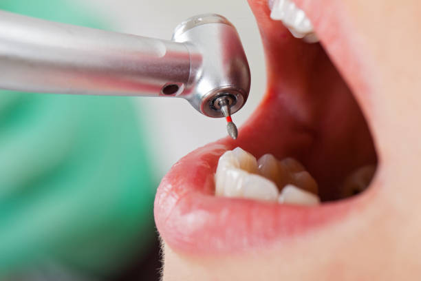 Best Emergency Root Canal Treatment in Edgerton, OH